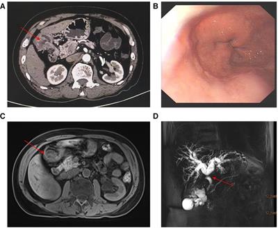 Adenocarcinoma developing from gastric heterotopic pancreas: a case report and short review